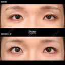HP 眼瞼下垂手術＋下眼瞼拡大術＋目尻切開 180日後 サムネイル用