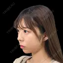 【あごヒアルロン酸】〜美人見えのヒミツは、あごにあり💎🤍〜 after画像 サムネイル用