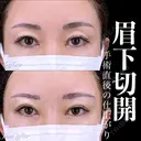 眉下切開 before画像 サムネイル用