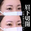 眉下切開 0日後 サムネイル用