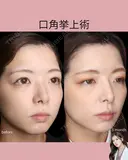 口角挙上 after画像 サムネイル用