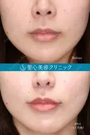 【20代女性鼻・唇・口角で上品な変化へ】①小鼻縮小+②人中短縮+③プレミアム口角挙上(10ヶ月後) before画像 サムネイル用