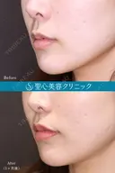 【20代女性鼻・唇・口角で上品な変化へ】①小鼻縮小+②人中短縮+③プレミアム口角挙上(10ヶ月後) after画像 サムネイル用