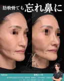 肋軟骨を使用した鼻中隔延長の症例です。 30日後 サムネイル用
