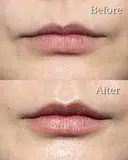 唇ヒアルロン酸 before画像 サムネイル用