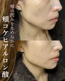 ハートシェイプ before画像 サムネイル用