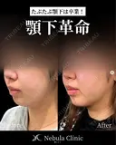 ⭐Dr都築⭐小顔カスタマイズ before画像 サムネイル用