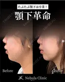 ⭐Dr都築⭐小顔カスタマイズ after画像 サムネイル用