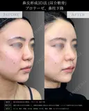 【鼻フル整形】鼻尖形成3D法＋耳介軟骨移植＋鼻柱下降＋プロテーゼ before画像 サムネイル用