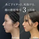 ベイザー併用アキーセル脂肪吸引(ホホ・ジョールファット・あご下) before画像 サムネイル用