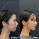 ベイザー併用アキーセル脂肪吸引(ホホ・ジョールファット・あご下) after画像 サムネイル用