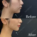ベイザー併用アキーセル脂肪吸引(ホホ・ジョールファット・あご下) after画像 サムネイル用