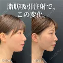 脂肪吸引注射 before画像 サムネイル用