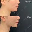 脂肪吸引注射 after画像 サムネイル用
