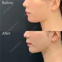 脂肪吸引注射 after画像 サムネイル用