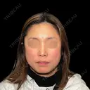 ✨美しさを引き上げる次世代フェイスデザイン糸リフト✨ before画像 サムネイル用