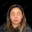 ✨美しさを引き上げる次世代フェイスデザイン糸リフト✨ 30日後 サムネイル用