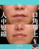 人中短縮と口角挙上の術後2週間の方です。 14日後 サムネイル用