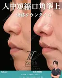 人中短縮と口角挙上の術後2週間の方です。 14日後 サムネイル用