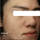 【ポテンツァCPチップ マックーム】 before画像 サムネイル用
