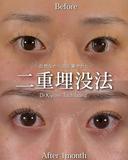 Zetith Eyes(3点留め埋没)  before画像 サムネイル用