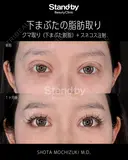 下まぶたの脂肪取り before画像 サムネイル用