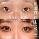 二重埋没(自然癒着6点留め) before画像 サムネイル用