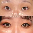 二重埋没(自然癒着6点留め) 180日後 サムネイル用