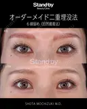 オーダメイド二重埋没法 before画像 サムネイル用