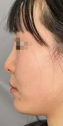 耳介軟骨移植+鼻尖形成 before画像 サムネイル用