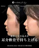 鼻整形（鼻柱を耳介軟骨で持ち上げる） after画像 サムネイル用