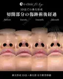 鼻整形（鼻柱を耳介軟骨で持ち上げる） before画像 サムネイル用