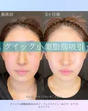 クイック小顔脂肪吸引・ルラリフト after画像 サムネイル用