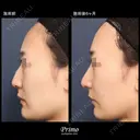 MR 鼻中隔延長術＋鼻背部軟骨移植術＋鼻尖形成術＋鼻翼縮小術（内側法＋外側法） 180日後 サムネイル用