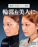 岩﨑先生による🔥小顔整形🔥 after画像 サムネイル用