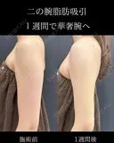 二の腕脂肪吸引 before画像 サムネイル用