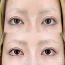 【アートメイク除去】他院薬剤除去2回... before画像 サムネイル用