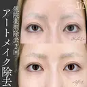 【アートメイク除去】他院薬剤除去2回... after画像 サムネイル用