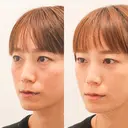 下眼瞼脱脂(経結膜)＋リガメント外し before画像 サムネイル用