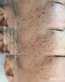 ほくろ取り　いぼ取り before画像 サムネイル用
