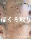 ほくろ取り　いぼ取り 1日後 サムネイル用