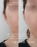 頬ヒアルロン酸 before画像 サムネイル用
