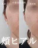 頬ヒアルロン酸 0日後 サムネイル用