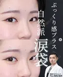 涙袋ヒアル after画像 サムネイル用