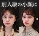 糸リフト+顔の脂肪吸引 after画像 サムネイル用