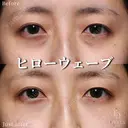 ヒローウェーブ（目の下） after画像 サムネイル用