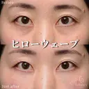 ヒローウェーブ（目の下） after画像 サムネイル用