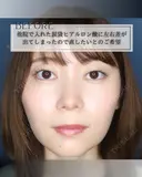 涙袋ヒアルロン酸 before画像 サムネイル用