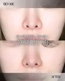 小鼻縮小 before画像 サムネイル用