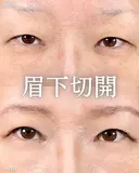 【眉下切開】でパッチリ目に👀 after画像 サムネイル用
